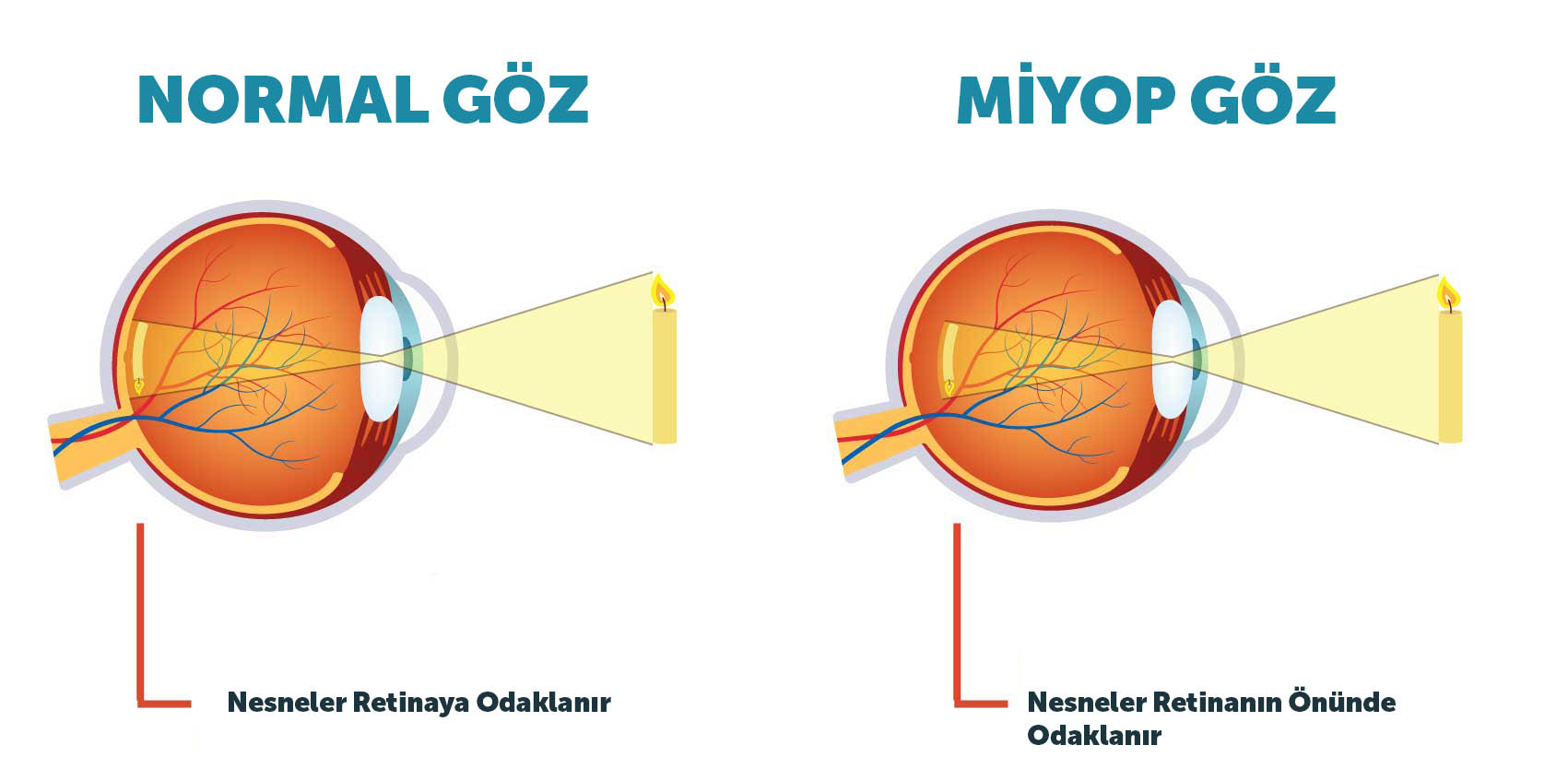 Miyoplu göz ve Normal Göz