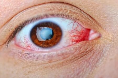 Üveit Nedir? Üveit Belirtileri, Nedenleri ve Tedavisi