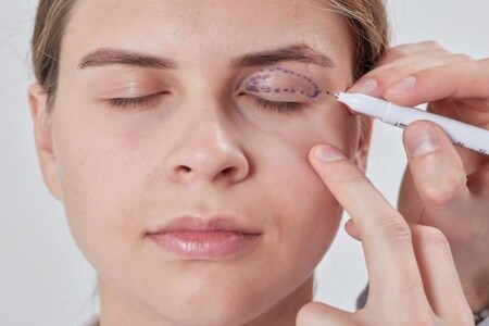 Göz Kapağı İltihabı (Blefarit) Nedir?