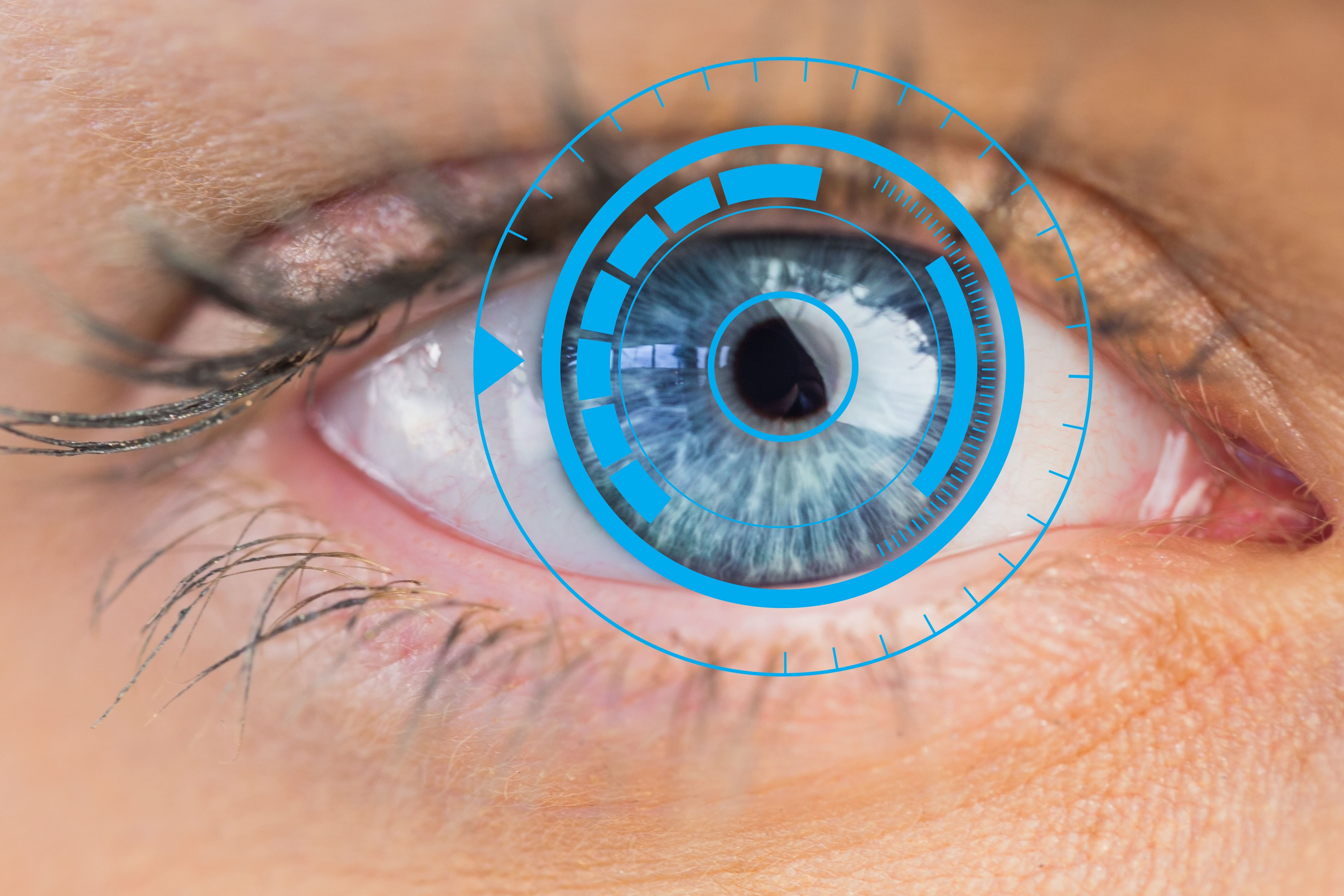 İLasik Nedir?