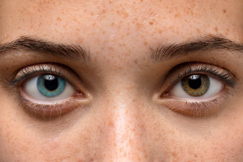 Heterokromi Nedir? Neden Olur?