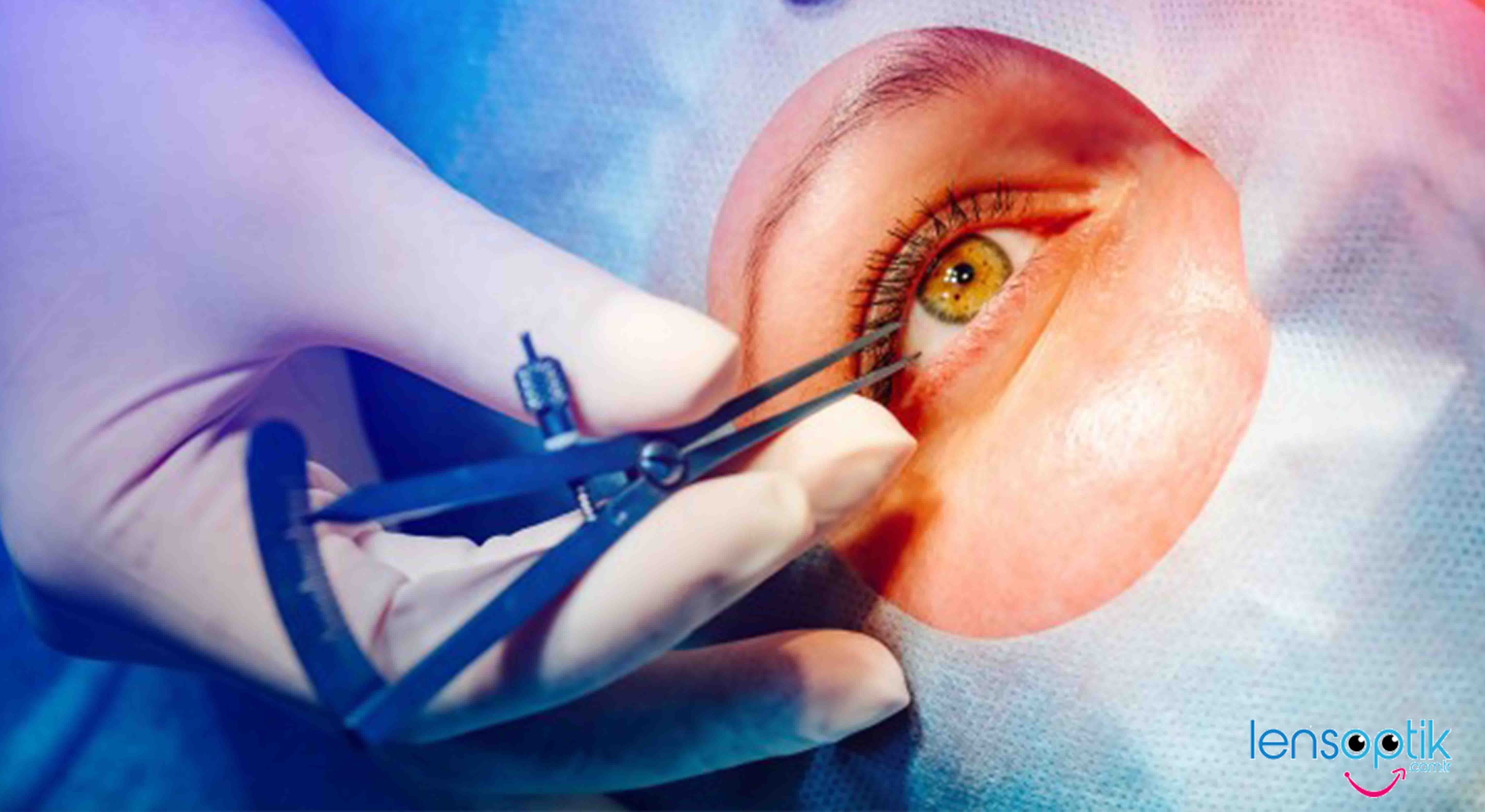 Göz Operasyonlarından Sonra Lens Kullanımı