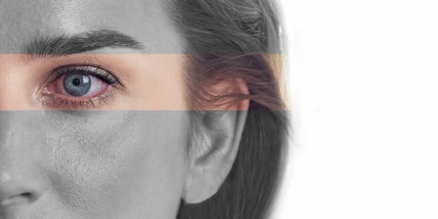 Kuru Göz Sendromu Nedir?